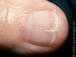 Split Nail