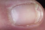Peeling Nail